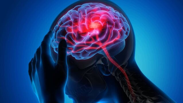<p>It is further estimated that stroke may account for up to 4% of healthcare costs. File image.</p>