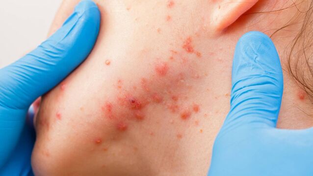 <p>Unlike adolescent acne, which tends to follow a more predictable pattern, adult acne can feel erratic, reactive, and harder to treat.</p>