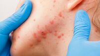 Acne skin