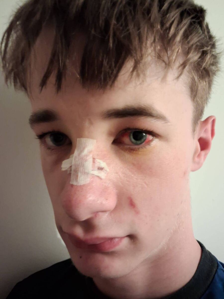 Logan McCarthy, who was attacked in Mahon with his brother.