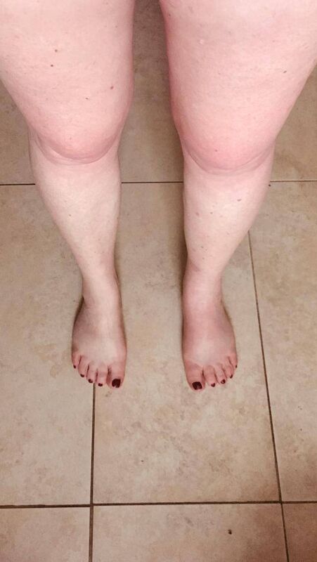 Living with Lymphoedema. Living with Lymphoedema.