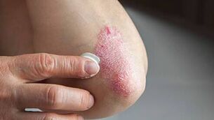 <p>Psoriasis can occur on any area of the body, but presents most commonly on knees, elbows, lower back and scalp. Picture: Stock</p>