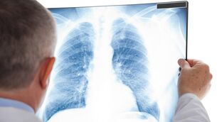 <p>There are about 2,500 cases of lung cancer every year, and 1,800 deaths. Picture: Stock</p>