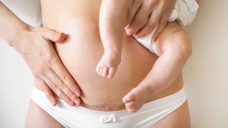 Why mothers need to celebrate and not hide C-section scars