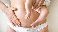 Why mothers need to celebrate and not hide C-section scars