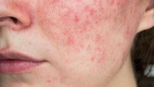 <p>Rosacea is inflammation of the skin, and a condition that causes redness of the face; particularly on the nose, cheeks, skin, forehead and eyelids. Picture: Stock</p>