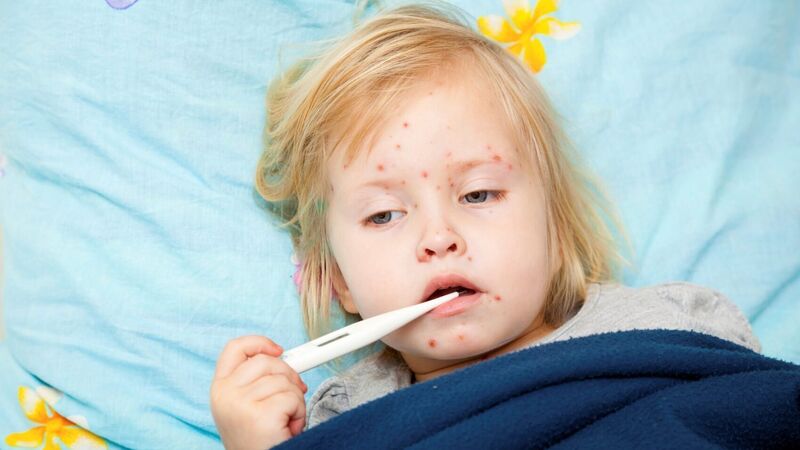 How to help your child when they have chickenpox How to help your child when they have chickenpox