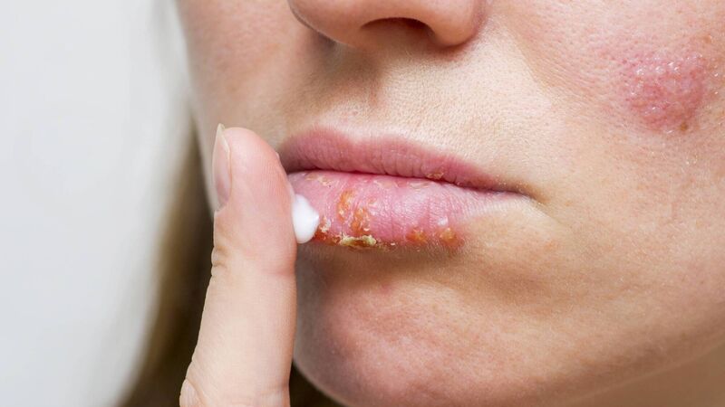 What to do if your child has impetigo... What to do if your child has impetigo...