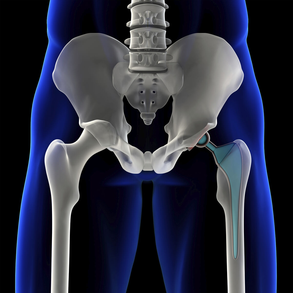 The Irish hip fracture database (IHFD) national report 2020 includes data from all 16 acute hospitals in the country on patients aged 60 years and over who were hospitalised following a hip fracture.