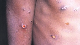 <p class="contextmenu internal_Caption">A case of monkeypox, from which about 1% of cases can die. However, we shouldn’t compare it to Covid-19, says Kathriona Devereux</p>