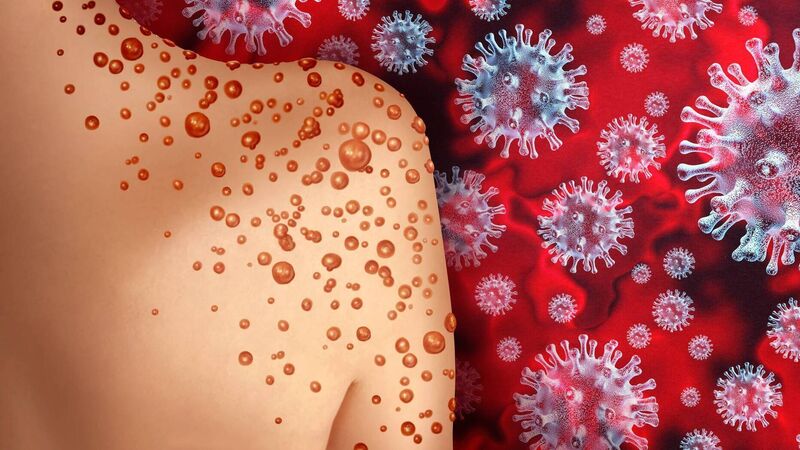 Cork professor says monkeypox should be a wake-up call