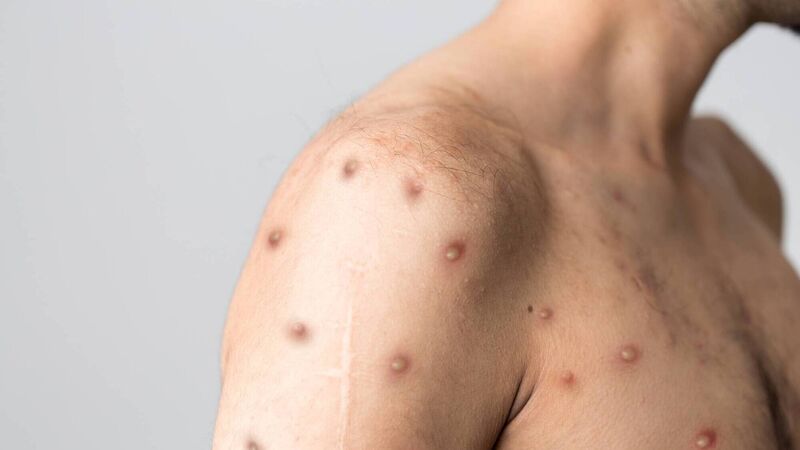 Virus recommendations are ‘good for those at high risk’, says Cork expert