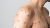 Monkeypox new disease dangerous over the world.