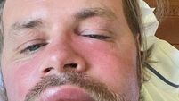 Brian McFadden suffers severe allergic reaction to bee sting