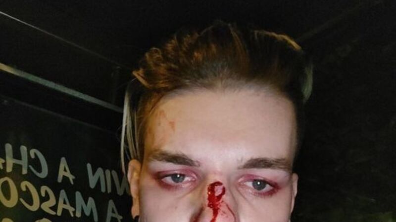 Young man assaulted in suspected homophobic attack on Dublin bus Young man assaulted in suspected homophobic attack on Dublin bus