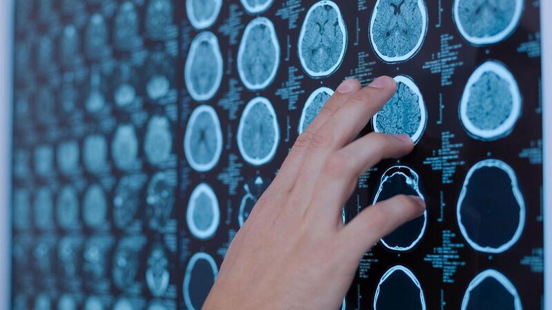 How to spot the symptoms of a brain tumour How to spot the symptoms of a brain tumour