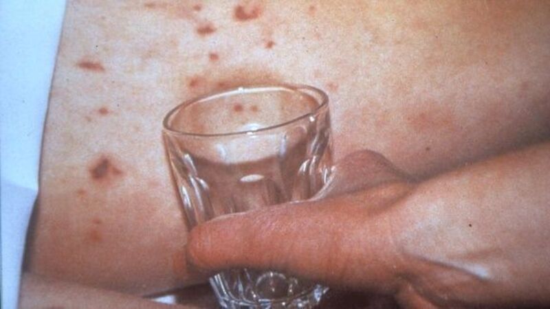 Parents urged to check children have MenB vaccine after two meningitis deaths Parents urged to check children have MenB vaccine after two meningitis deaths