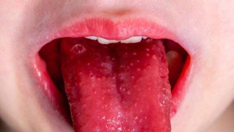 Parents warned to look out for Strep A symptoms due to weakened immune systems