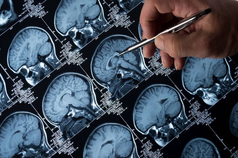 40,000 people in Ireland have epilepsy.