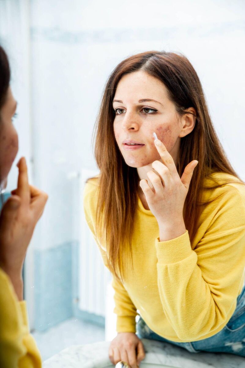 Most people grow out of acne, but breakouts can still happen as an adult. Most people grow out of acne, but breakouts can still happen as an adult.