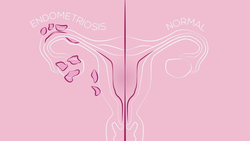 3 women open up about life with Endometriosis