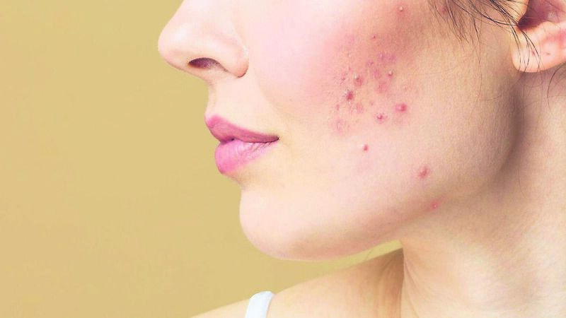 My acne journey... I still have it at 38