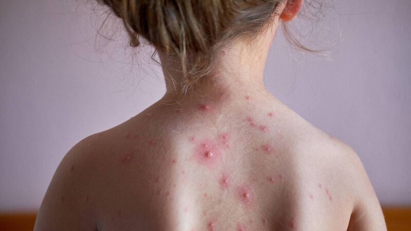 Tips for dealing with chickenpox