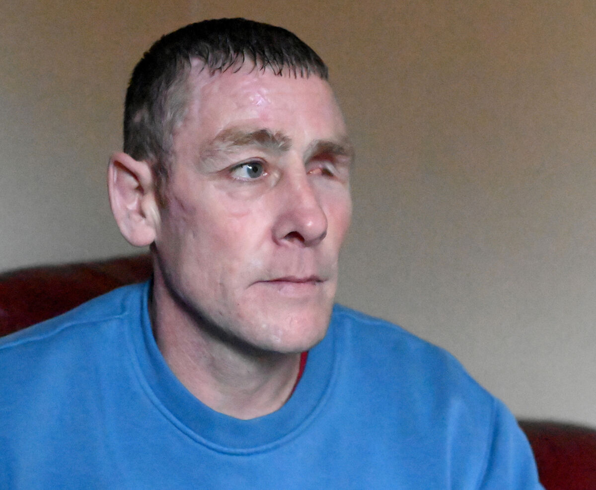 Francis Costello, with the scars of the attack at his home in Ballyphehane where the incident took place. Picture: Eddie O'Hare