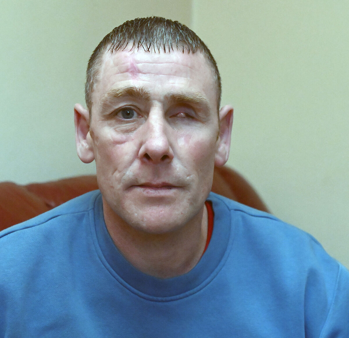 Medical professionals persevered unsuccessfully to save Francis’s eye.