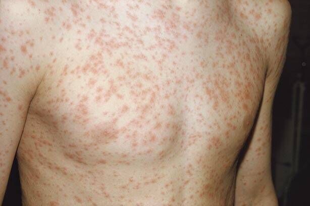 Measles rash on male child. Measles rash on male child.