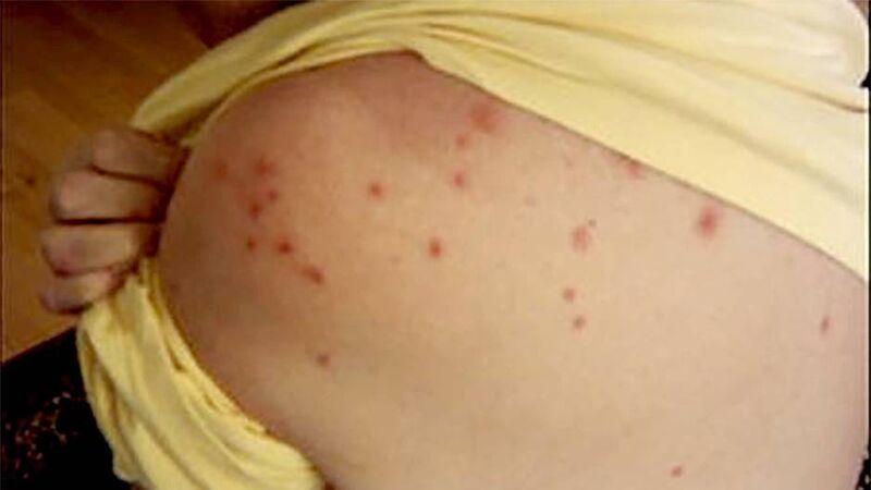Sixth measles case in Cork-Kerry in weeks
