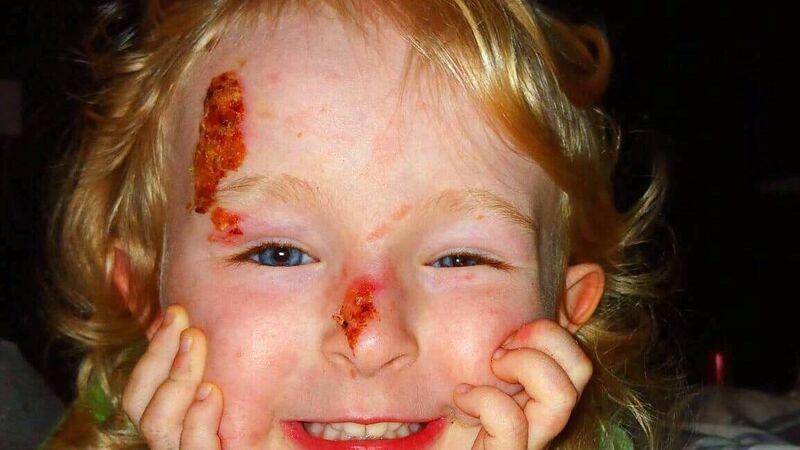 'I wish I didn’t need to have my bandages changed on Christmas Day,' Cork schoolgirl with painful skin condition says