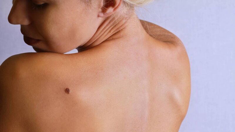 Dr Michelle O'Driscoll: Recognising the signs of skin cancer Dr Michelle O'Driscoll: Recognising the signs of skin cancer