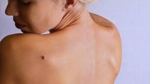 <p class="contextmenu Body Body">Most moles, brown spots and growths on the skin are harmless – but not always, says Dr O'Driscoll. </p>