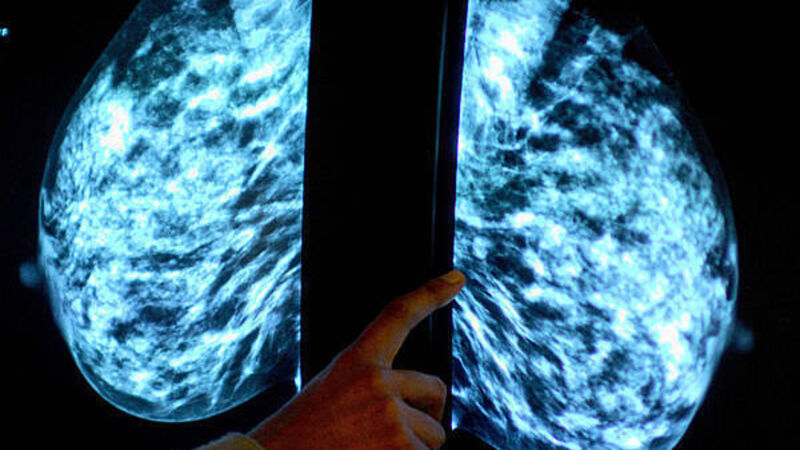 HSE breast cancer screening programme misses targets for past two years HSE breast cancer screening programme misses targets for past two years